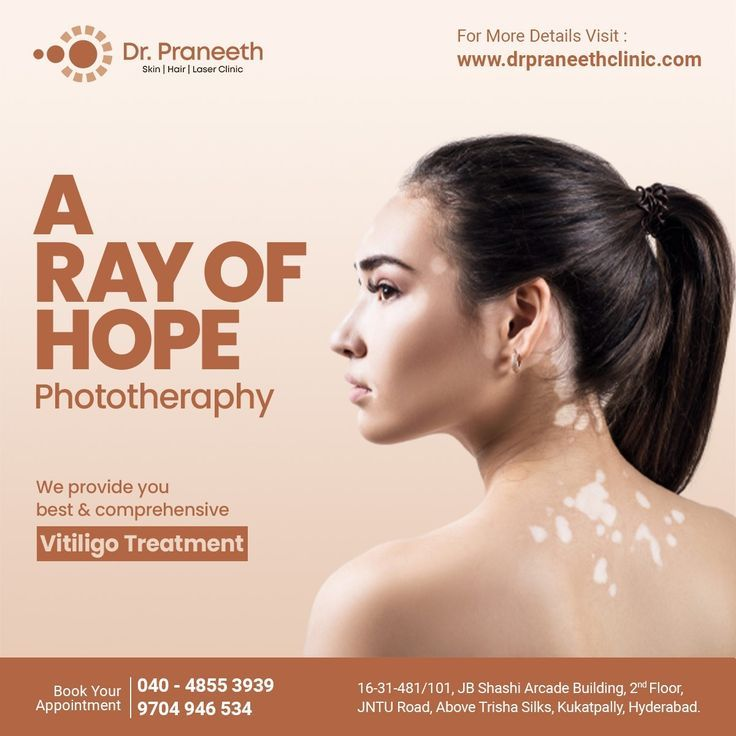 Vitiligo Treatment