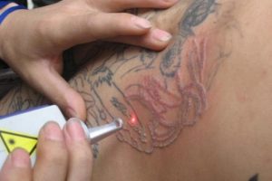 tattoo-removal